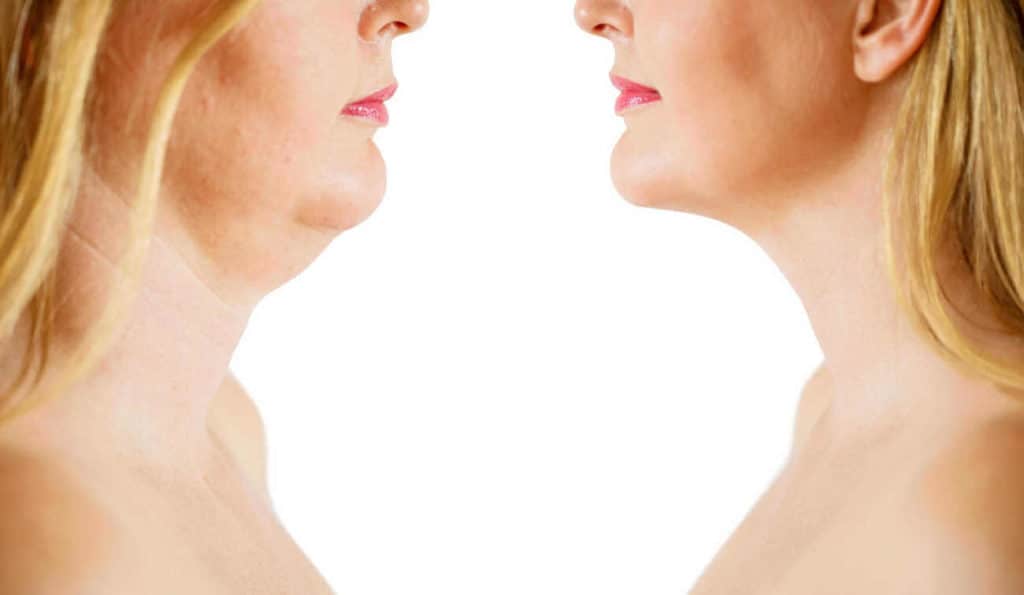 Double Chin treatment Upper Walthamstow before and after results