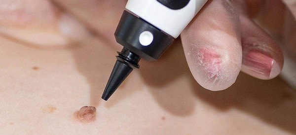 After Skin Tag Removal Upper Walthamstow