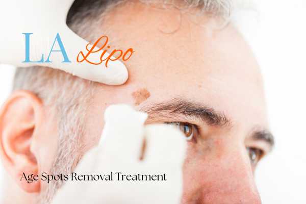 What Are the Most Effective Treatments for Age Spots Upper Walthamstow?