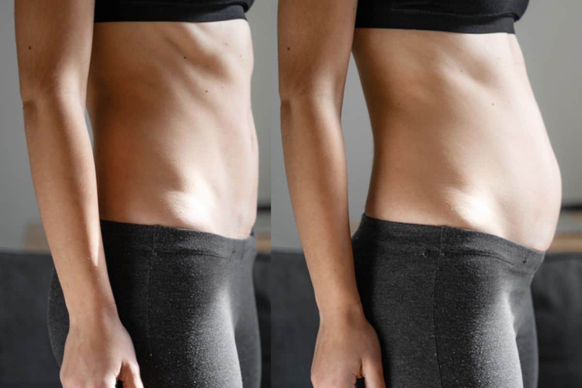 How long does diastasis recti take to improve Upper Walthamstow?