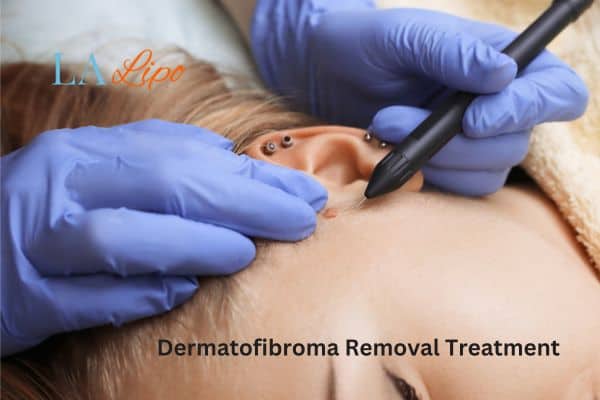 Dermatofibroma Removal Treatment Upper Walthamstow