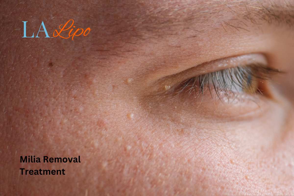 Cryopen Milia Removal: Is It the Easiest and Safest Option Upper Walthamstow?