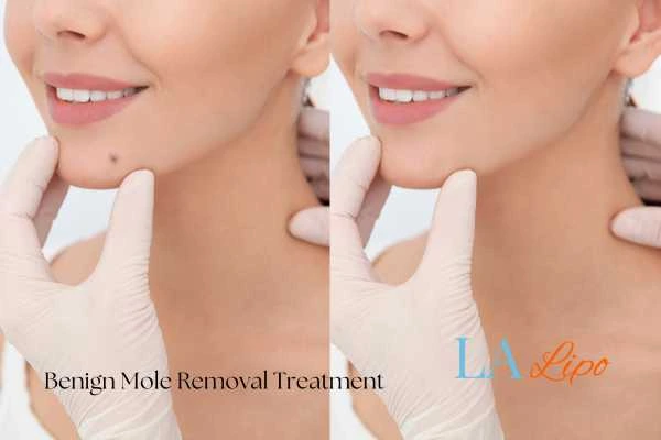 woman's before and after mole removal Upper Walthamstow results