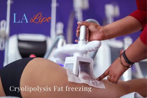 women getting fat freezing Upper Walthamstow