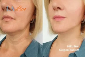 hi-fu for wrinkles Upper Walthamstow before and after results
