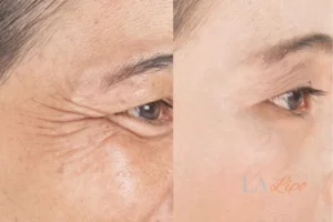 Before and after results of woman - HI-fu wrinkles reduction treatment Upper Walthamstow