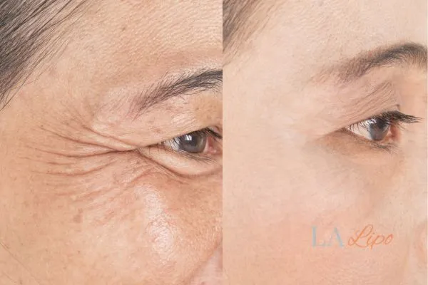 Before and after results of woman - HI-fu wrinkles reduction treatment Upper Walthamstow