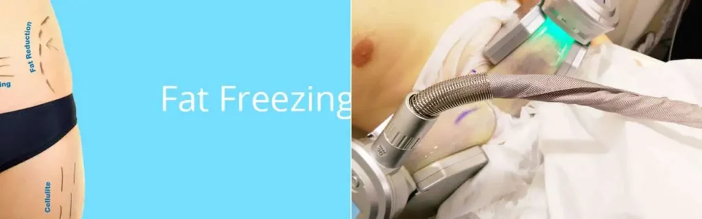 Fat freezing Upper Walthamstow on multiple areas of the body