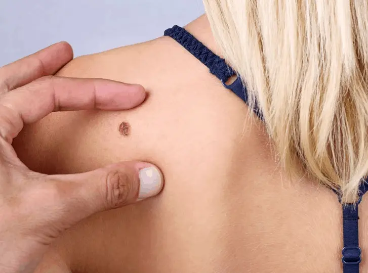 woman having mole removal Upper Walthamstow consultation before treatment.