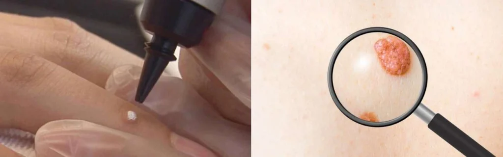 CryoPen practitioner Upper Walthamstow assessing a benign mole before treatment