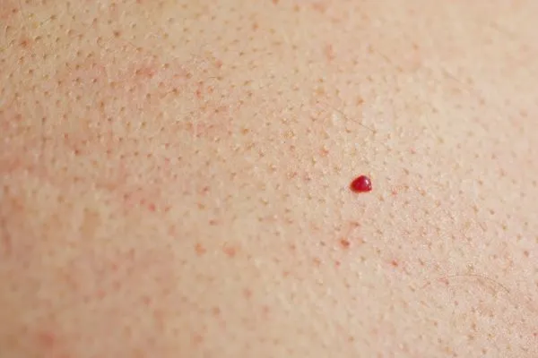 close up of a cherry angioma Upper Walthamstow