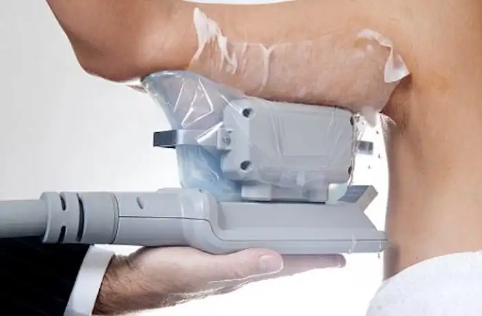 Picture of fat freezing Upper Walthamstow on the upper arms.