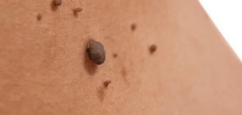 image of a skin tag Upper Walthamstow