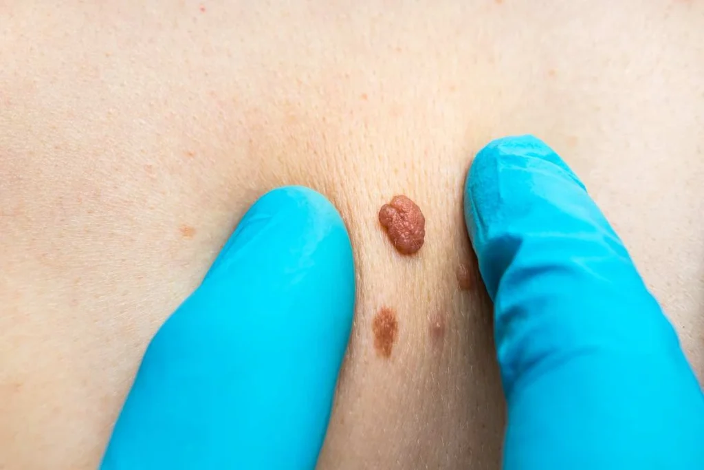Consultant examining a skin tag Upper Walthamstow