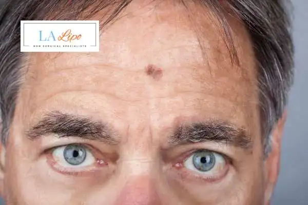 Solar Lentigo Removal Upper Walthamstow image of man with mark on his forehead