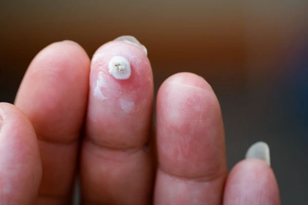 wart on person finger - cryotherapy to treat from LA LIPO Upper Walthamstow