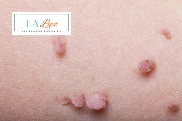 Does cryopen skin tag removal Upper Walthamstow hurt? Find out now call our team today!