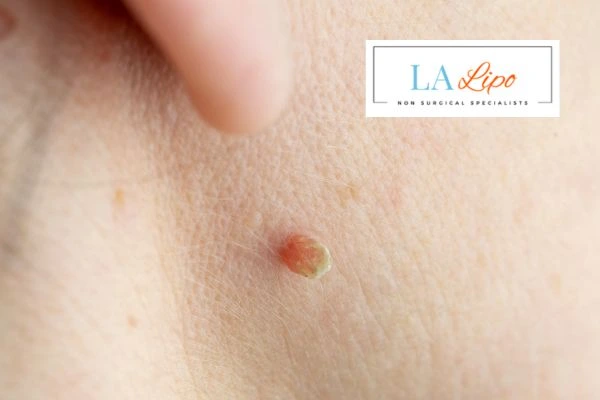 Book skin tag removal Upper Walthamstow today speak to our team now!
