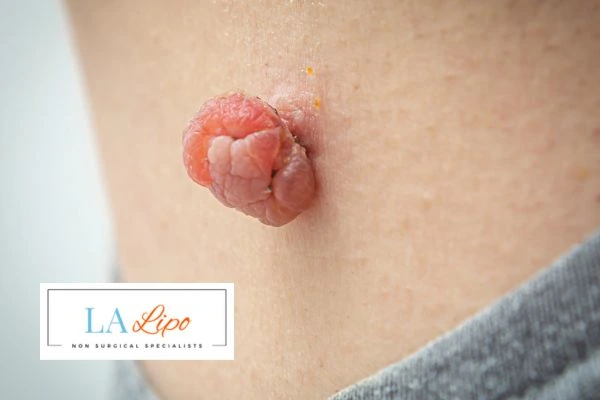 Interested in skin tag removal Upper Walthamstow? Concerned about the pain? Find out more today!
