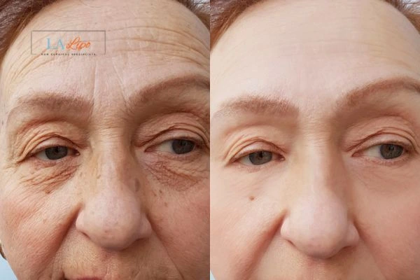 The powerful benefits of Morpheus8 Treatment Upper Walthamstow - Call Our team today!