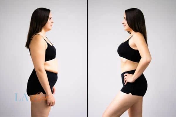 Picture of womans before and after using LA-EMS body sculpting to improve her core strength Upper Walthamstow