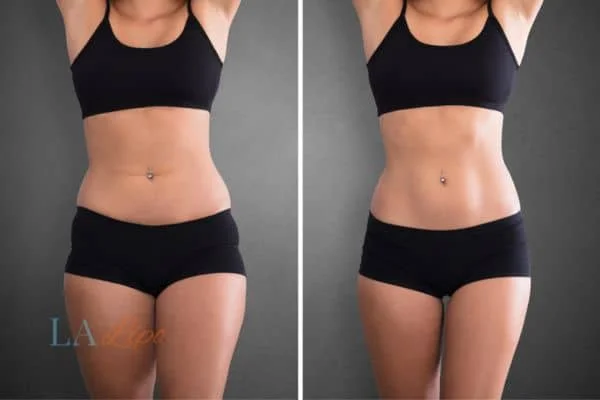 before and after results of non-surgical treatment to help a woman's body image and mental health Upper Walthamstow