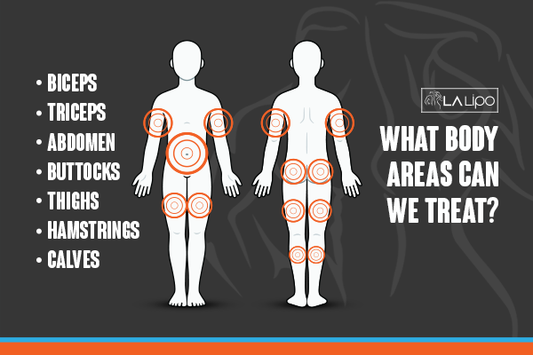 Diagram to show areas you can have LA-EMS Body Sculpting Treatment Upper Walthamstow