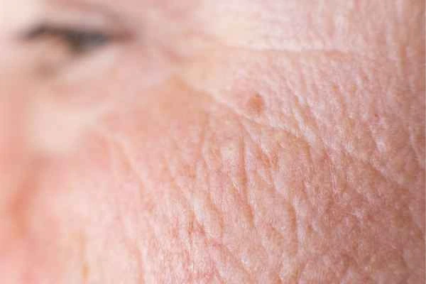 close up picture of a woman's face showing an age spot Upper Walthamstow
