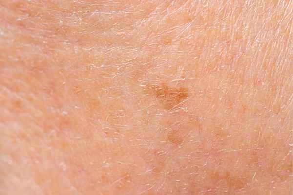 close up picture of age spots Upper Walthamstow
