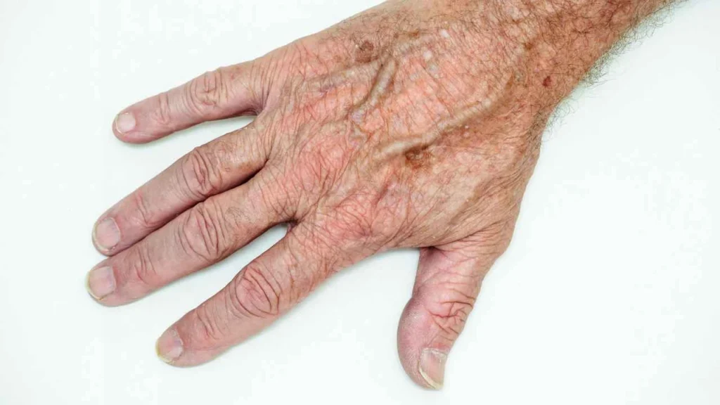 Male hand showing age spot Upper Walthamstow