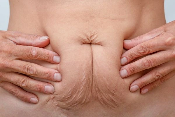 Image of a woman's stomach with loose skin - example of skin tightening Upper Walthamstow options