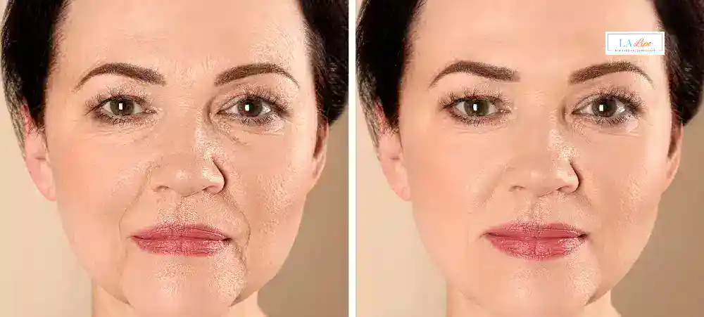How Long Does It Take to See Results and How Long Do They Last Upper Walthamstow?