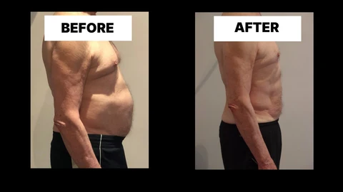 What Symptoms Can Diastasis Recti Cause in Men? Weak Core, Back Pain and Poor Posture Upper Walthamstow